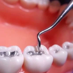 A nagy amalgám kérdés