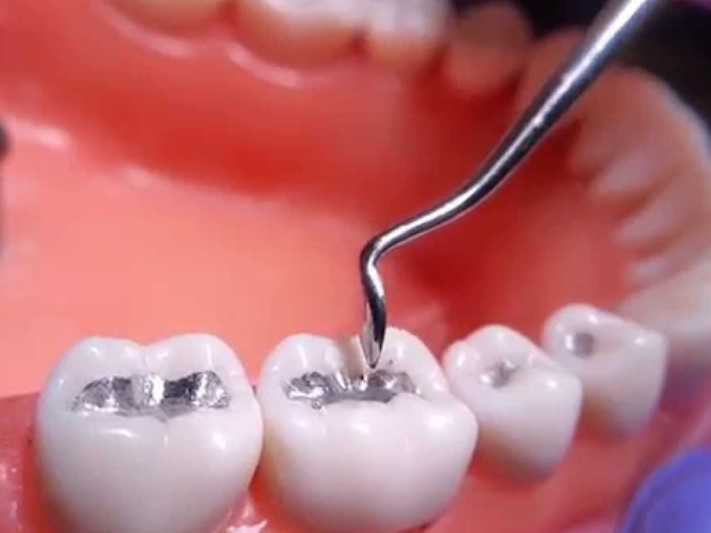 A nagy amalgám kérdés